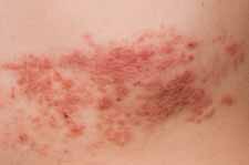 Shingles facts, suggestions and information about Shingles prevention, treatment and symptom relief